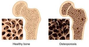 kaulu osteoporoze